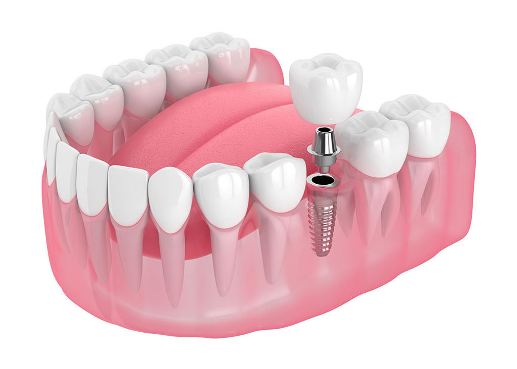 dental implant treatment dental clinic at Mangalabag Cuttack xl dental care