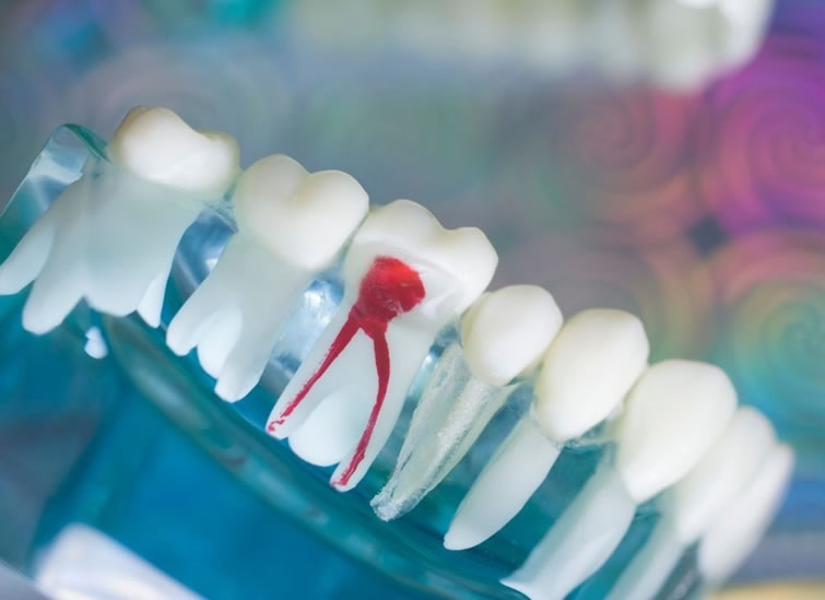 root canal treatment at xl dental care Mangalabag Cuttack